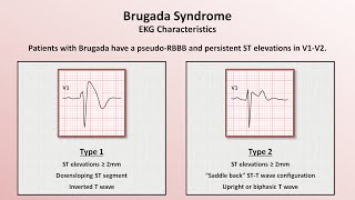 Advanced EKGs  Sudden Cardiac Death Hypertrophic cardiomyopathy ARVD Brugada syndrome and CPVT [upl. by Ed114]