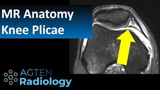 MRI Anatomy of Knee Plicae [upl. by Ettennal]