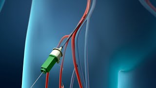 Angioplasty Procedure Animation Video [upl. by Okoy]