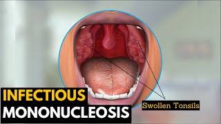 Infectious mononucleosis Causes Signs and Symptoms Diagnosis and Treatment [upl. by Nelsen]