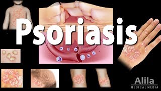 Psoriasis Types Symptoms Causes Pathology and Treatment Animation [upl. by Geier5]