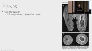 Chronic osteomyelitis [upl. by Narine]