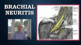 Brachial Neuritis  Parsonage Turner Syndrome [upl. by Lydia524]