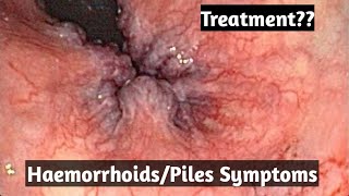 HaemorrhoidsPiles treatment what are its symptoms [upl. by Desimone]