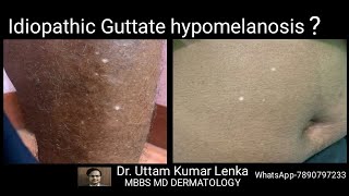 White spots on skin in old age idiopathic guttate hypomelanosis Treatment and prevention [upl. by Dessma865]