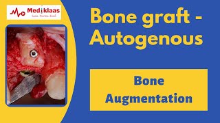 Autogenous Bone Grafts [upl. by Fina283]