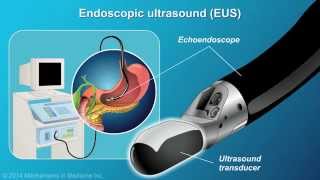 Understanding EUSFNA [upl. by Alyak]