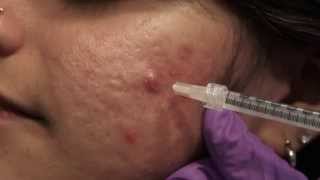 Watch amp Learn Intralesional injections [upl. by Aniret140]