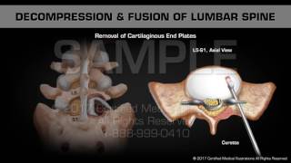 Decompression amp Fusion of Lumbar Spine [upl. by Notgnillew]