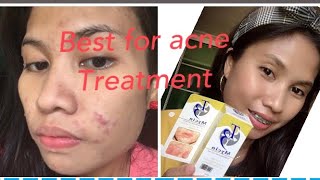 THE BEST FOR ACNE TREATMENT THE T3 MYCIN CLINDAMYCIN LOTION [upl. by Meldoh]