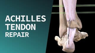 Achilles Tendon Repair [upl. by Preiser600]