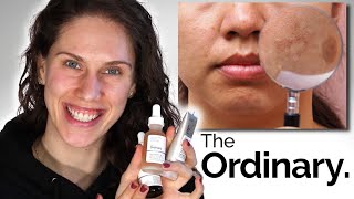 THE ORDINARY  3 BEST DARK SPOTS amp PIGMENTATION PRODUCTS [upl. by Ier]