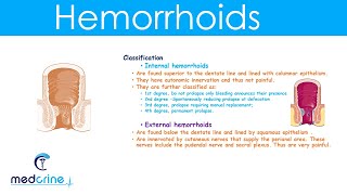 Hemorrhoids  causestypesclinical featuresdiagnosis and treatment [upl. by Freeland]