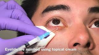 Steroid injection for chalazion [upl. by Nivalc]