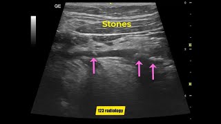 Submandibular duct stones [upl. by Ielak467]