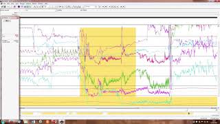 How to Analyze a pHImpedance tracing ESNM teaching video [upl. by Matthaus647]