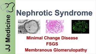 Nephrotic vs Nephritic Syndrome Proteinuria Hematuria Casts [upl. by Tadich]