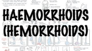 Haemorrhoids Hemorrhoids  Overview pathophysiology investigations and treatment [upl. by Loats388]