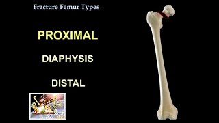 Fracture Femur Types  Everything You Need To Know  Dr Nabil Ebraheim [upl. by Froma]