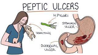 Understanding Stomach and Duodenal Ulcers [upl. by Ardnoel]