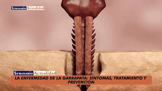 La enfermedad de la garrapata Síntomas tratamiento y prevención [upl. by Renba]