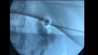 Gastrostomy Tube Placement GTube by Interventional Radiology  BackTable Demo [upl. by Nwahsir]