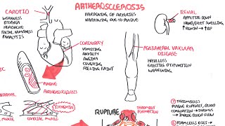 Atherosclerosis  Pathophysiology [upl. by Blanca650]