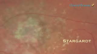 Stargardt Macular Dystrophy [upl. by Narag]