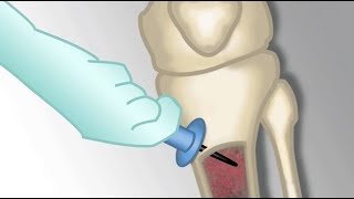 Placement of an Intraosseous Line by MKleinman  OPENPediatrics [upl. by Reginald68]