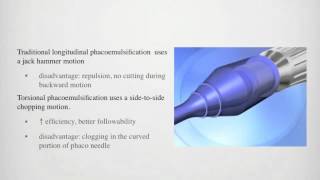 Torsional phacoemulsification surgery  Video abstract 35283 [upl. by Tiffany408]