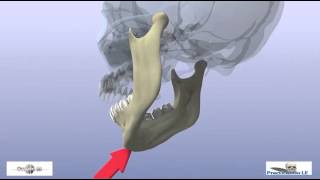 fractures of the mandibular condyle [upl. by Ynos]