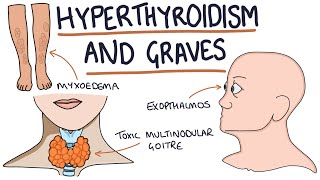 Understanding Hyperthyroidism and Graves Disease [upl. by Nace]