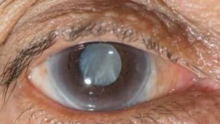 New eye drops may help treat cataracts [upl. by Aikahs]