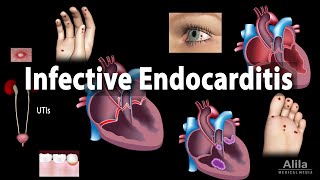 Infective Endocarditis Animation [upl. by Araek324]