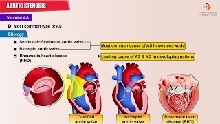 Bicuspid Aortic Valve and Congenital Aortic Stenosis Wilson Lam MD [upl. by Gudren154]