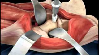 Hip replacement surgery techniques  Dr Scott Devinney [upl. by Atelra]