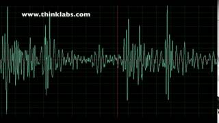 Aortic Stenosis Explained Clearly  Diagnosis and Treatment [upl. by Carolynne573]