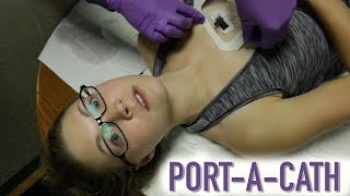 HOW TO ACCESS A PORTACATH IMPLANTED PORT [upl. by Purington]