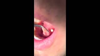 Sialolith removal from submandibular duct [upl. by Haimarej941]