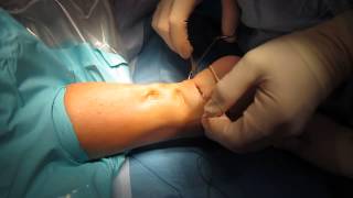 Percutaneous Achilles Tendon Surgery Repair Unedited by Kevin R Stone MD [upl. by Renmus]