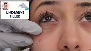 Cannula Method for Fillers  Dr Nissan Pilest Irvine CA [upl. by Herve]