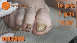 Onicauxis onychomycosis amp callosities Part 1 podologiaintegral [upl. by Holey]