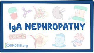 Nephritic syndrome  Acute proliferative glomerulonephritis  PSGN  Pathology  Handwritten notes [upl. by Tugman692]