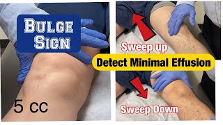 Bulge SignDetect Minimal Knee Effusion [upl. by Pavior]