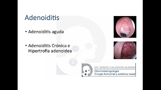 4 Adenoiditis [upl. by Eddi]