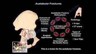 Acetabular Fracture T Shaped Fracture  Everything You Need To Know  Dr Nabil Ebraheim [upl. by Imeaj131]