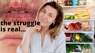 Eczema on the Lips  What Foods to Eat and Avoid When You Have Angular Cheilitis or Lip Eczema [upl. by Ecnarolf]