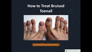 How to treat Bruised Toenail [upl. by Timothy]