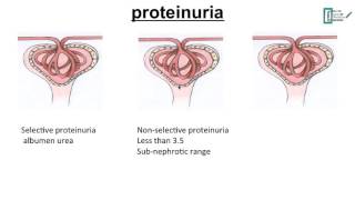 Webinar Nephrotic syndrome and FSGS [upl. by Enomor889]