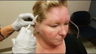 Botox Injection for Chronic Migraine [upl. by Nicolle883]